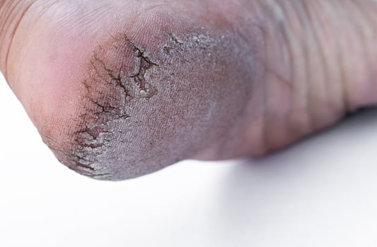 Close up crack heel further deep cracks and dry flaky skin photo