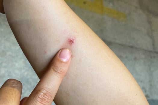 a beginning Ring Worm infection, Dermatophytosis on skin. Applying an emollient to dry flaky skin photo