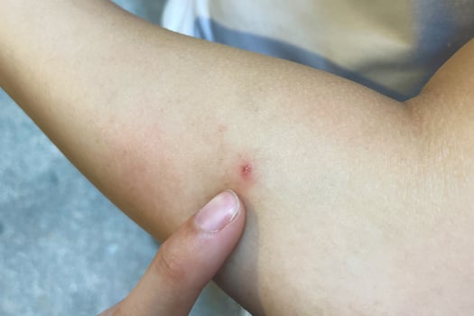 a beginning Ring Worm infection, Dermatophytosis on skin. Applying an emollient to dry flaky skin. photo