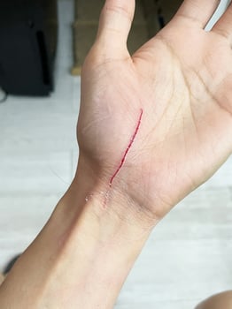 cat scratch wounds on human hand. cat scratche that cause on chest wounds photo