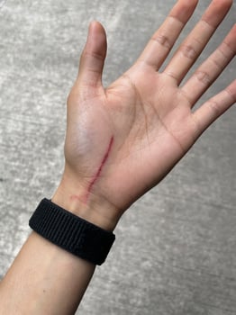cat scratch wounds on human hand. cat scratches that cause on chest wounds photo