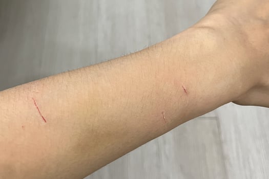 cat scratch wounds on human hand. cat scratches that cause on chest wound photo