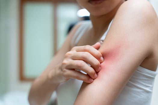 skin problem and beauty Young woman scratch body has itchy skin from skin allergic, steroid allergy, sensitive skin, red from sunburn, chemical allergy, rash, insect bites, Seborrheic Dermatitis. photo