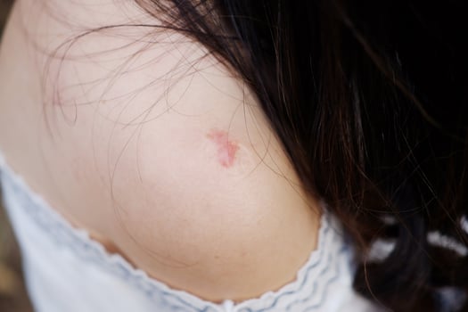 Close up BCG vaccination scars awaken an abscess on shoulder of Asian woman. Bacillus Calmette Gurin vaccine photo