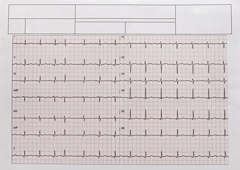 Detailed EKG, ECG, electrocardiogram showing heartbeat patterns. photo