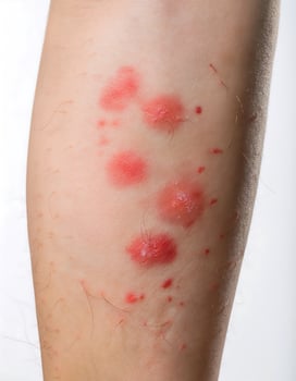 Dermatitis Symptoms Inflamed and Itchy Skin on Leg photo
