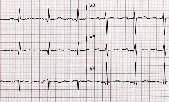Closeup of a standard electrocardiogram, EKG, graph paper. Health and medical concepts. photo