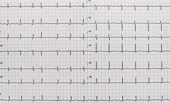 Detailed EKG, electrocardiogram photo