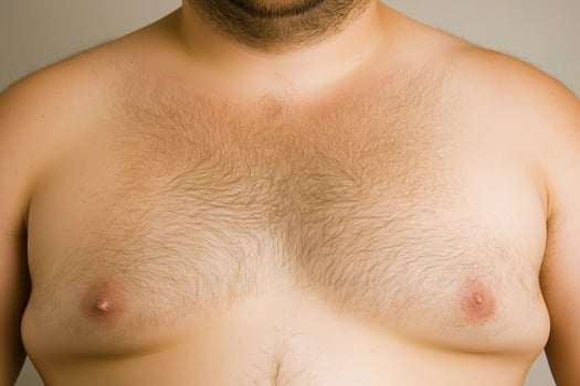Overweight male breasts with chest hair and gynecomastia. Man or moobs. photo
