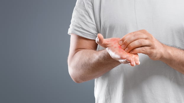 Annoyed middle aged bearded man scratching his red palm on grey studio background, copy space. Caucasian man suffering from allergic reaction, psoriasis or eczema, having itchy hands photo