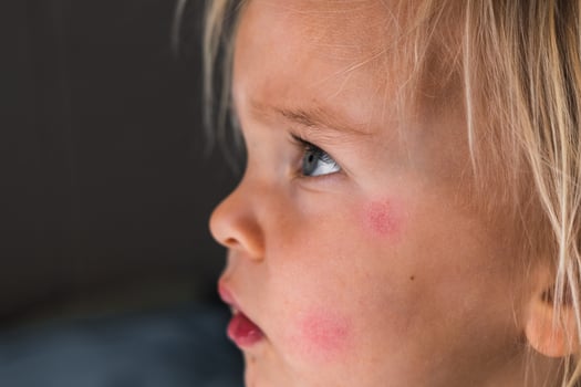 portrait of little toddler blonde girl with allergic rash or eczema on face. photo