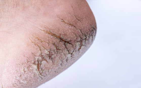Crack heel further deep cracks and dry flaky skin photo