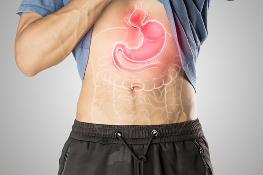 Hiatal Hernia causes upper stomach bulge, shown in medical illustration. photo