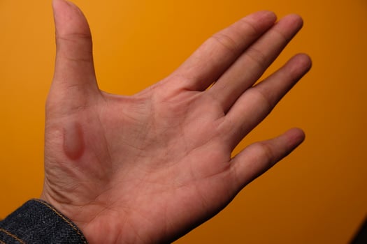 burns on the palms. blistered palms photo