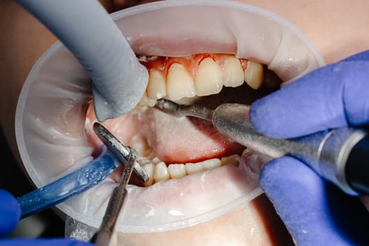 Dentist performing dental checkup cleaning teeth of patient wearing protective glove photo