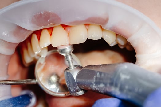 Dentist performing dental checkup cleaning teeth of patient wearing protective glasses. photo
