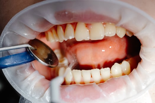 Dentist performing dental checkup cleaning teeth of patient wearing protective glasses photo