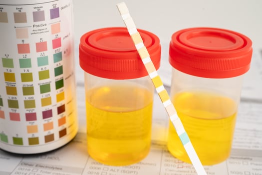 Urinalysis, urine cup with reagent strip pH paper test chart photo