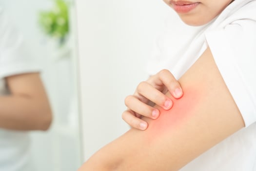 skin problem and beauty. woman scratch body has itchy skin from skin allergic, steroid allergy, sensitive skin, red from sunburn, chemical allergy, rash, insect bites, Seborrheic photo