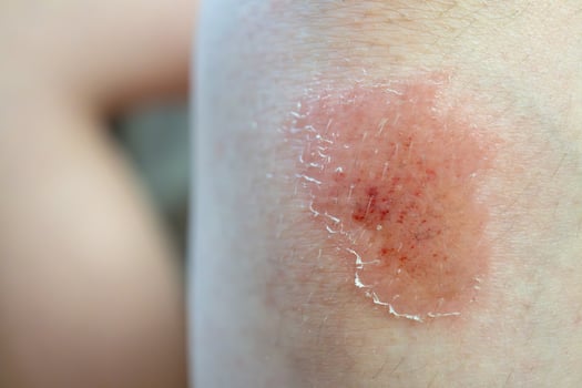 Close-up of healing skin with redness and peeling on caucasian boy photo