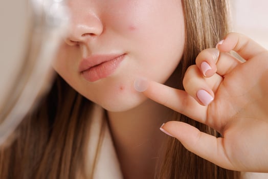 Girl placing hydrocolloid patch on acne spot for pimple treatment and skincare. photo
