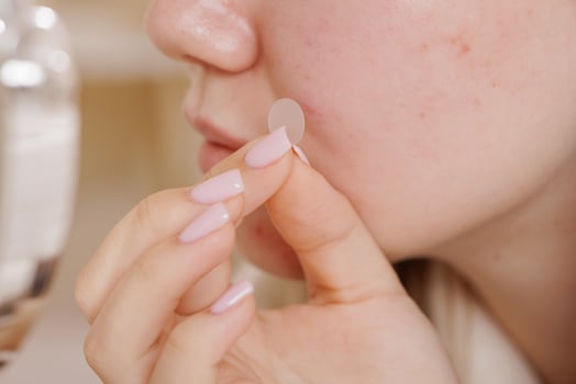 Close view of female hand placing pimple patch on irritated skin to treat facial acne. photo