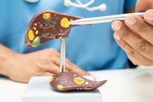 Cirrhosis, Liver cancer, fatty liver, Asian doctor with liver human photo
