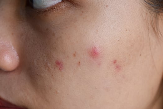Acne on Woman's Cheek, Closeup View of Skin Blemishes and Inflammation. photo