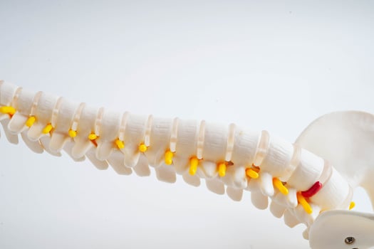 Spinal nerve and bone, Lumbar spine displaced herniated disc fragment, Model for treatment medical in the orthopedic depart photo