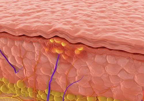 Skin lesion anatomy illustration photo