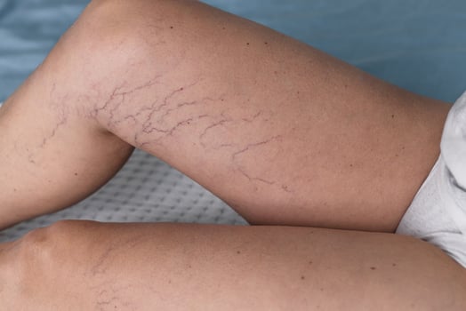 Visible veins on legs of a person sitting on a bed in a light-colored room photo