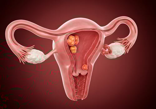 Female reproductive system with internal growths photo