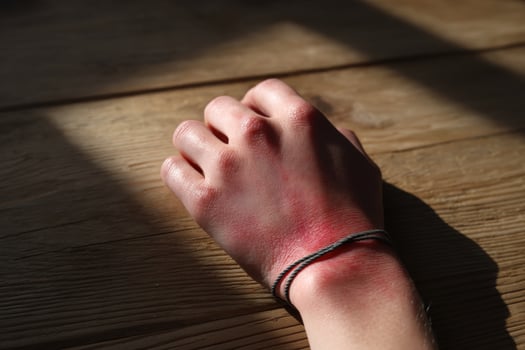 Hand with sunburn marks resting on a wooden table in soft afternoon light photo