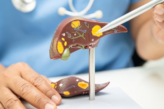 Cirrhosis, Liver cancer, fatty liver, Asian doctor with liver human anatomy model. photo
