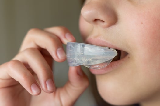 A child or girl inserts a mouth guard into her mouth to straighten her teeth or bite. Teeth aligners. Close-up side view photo