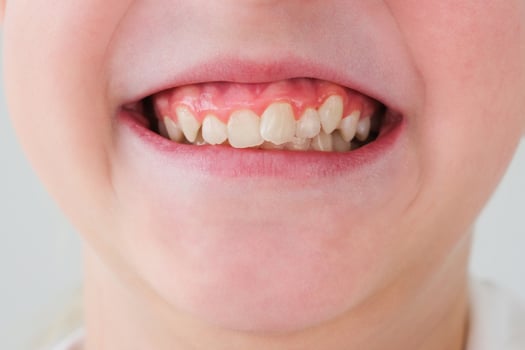 Child has crooked teeth. The concept of crowding of molars photo