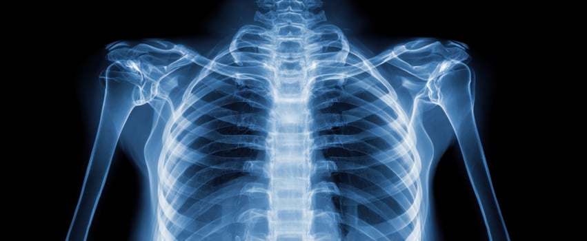 The detailed x-ray image showcasing the human skeletal system and ribcage. photo