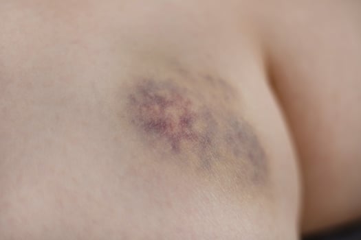 Close-up of healing bruise showing purple and yellow colors. bruise on inner thigh near knee photo