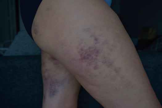 A woman with bruises on her legs photo