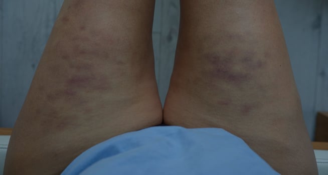 A person with red skin on their legs photo
