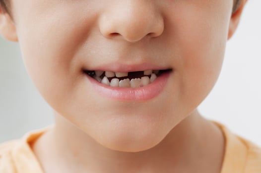 The smile of a little boy without a baby tooth. The child's front baby tooth falls out and a new adult tooth grows. Oral care in children. photo