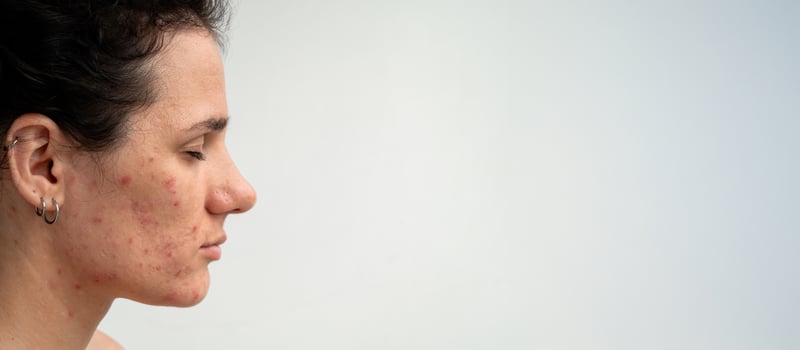 Close-up portrait of a young Caucasian woman with skin problems - pimples, acne, enlarged pores. photo
