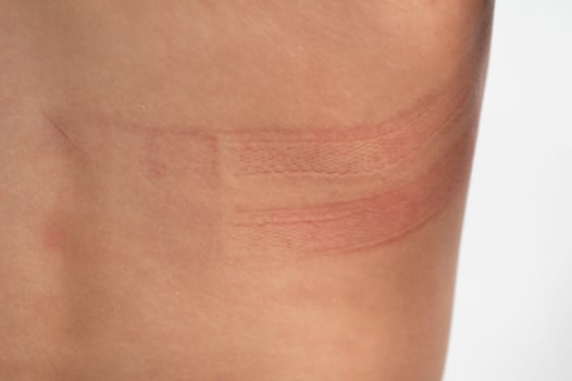 Bra marks on the back. The girl rubbed her back with her underwear. Uncomfortable bra. The wrong size underwear,. photo