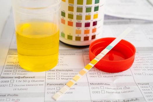 Urinalysis urine cup with reagent strip pH paper test and comparison chart photo