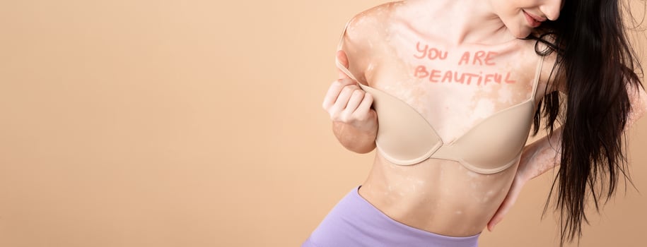 Woman With Vitiligo Skin Disorder With You Are Beautiful Motivational Inscription On Her Chest Posing In Underwear Over Beige Studio Background, Young Attactive Female Enjoying Natural Beauty, Closeup photo