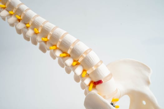 Spinal nerve and bone, Lumbar spine displaced herniated disc fragment, Model for treatment medical in the orthopedic photo