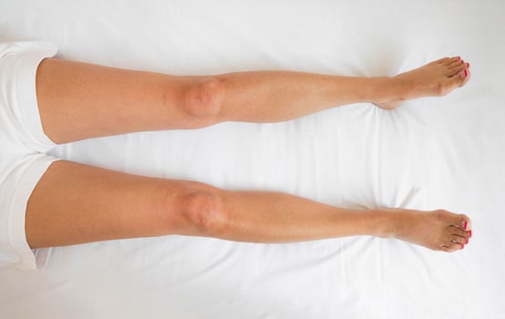 closeup of woman legs lying flat on white bed in bright medical setting, swelling, concept of lymphedema diagnosis, recovery, orthopedic assessment, physical therapy care photo