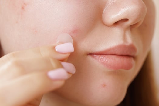 Closeup Woman Applying Acne Patch on Face Skincare Treatment with Hydrocolloid Pimple Patch photo