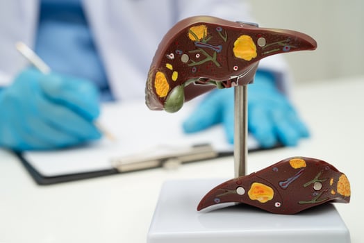 Cirrhosis, Liver cancer, fatty liver, Asian doctor with liver human anatomy model in World Hepatitis Day photo