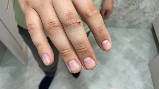Patient in hospital with cut fingers, bloody wound treated by doctor, man's hands, medical care, doctor's appointment photo